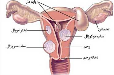 برداشتن رحم به دلیل میوم